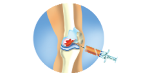 Injekcia Orthokin koleno